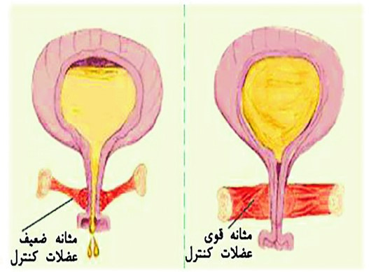 افتادگی مثانه